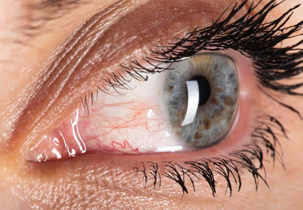 Wearing contact lenses can sometimes irritate already sensitive eyes